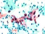 VOA慢速英语:Traditional Test for Cervix Cancer Being Used to Test for Other Cancers